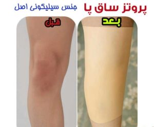 پروتز ساق پا